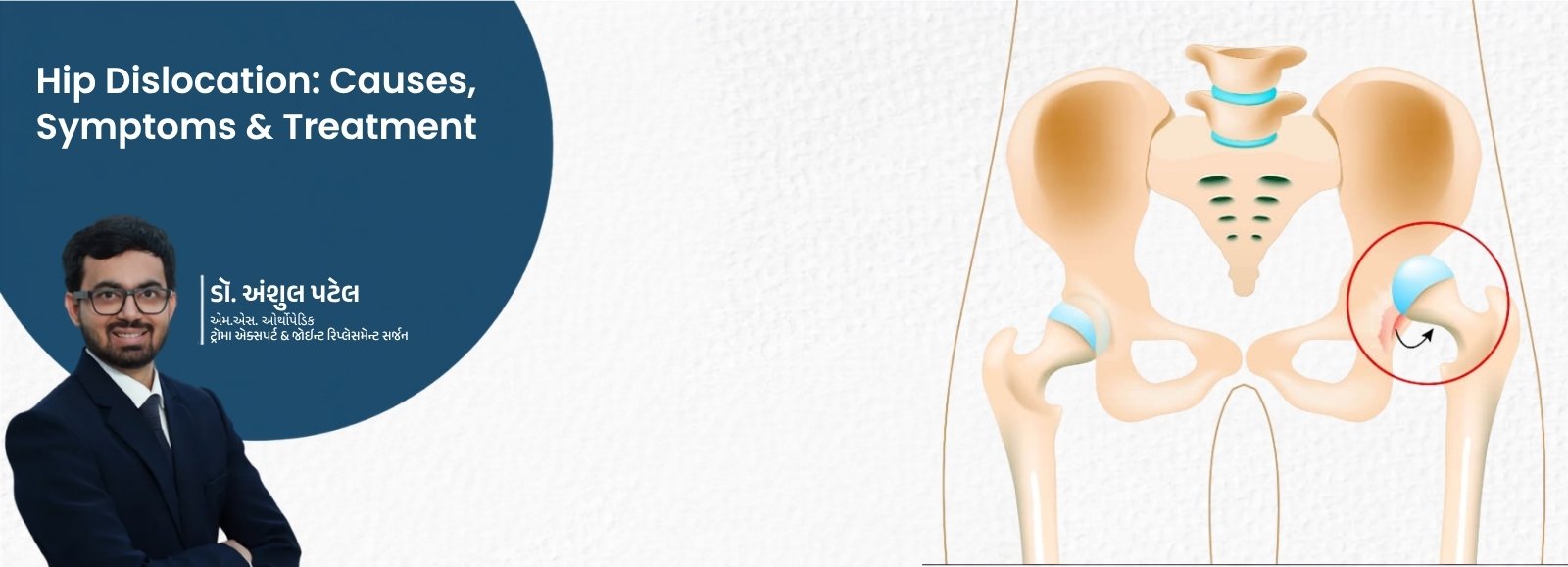 Hip Dislocation: Causes, Symptoms & Treatment