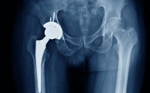 Hip Replacement