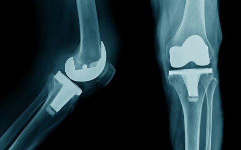 Knee Replacement