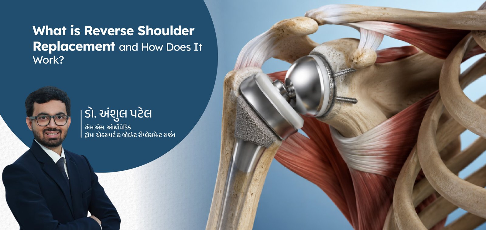 What is Reverse Shoulder Replacement and How Does It Work?