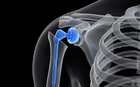 Shoulder Replacement